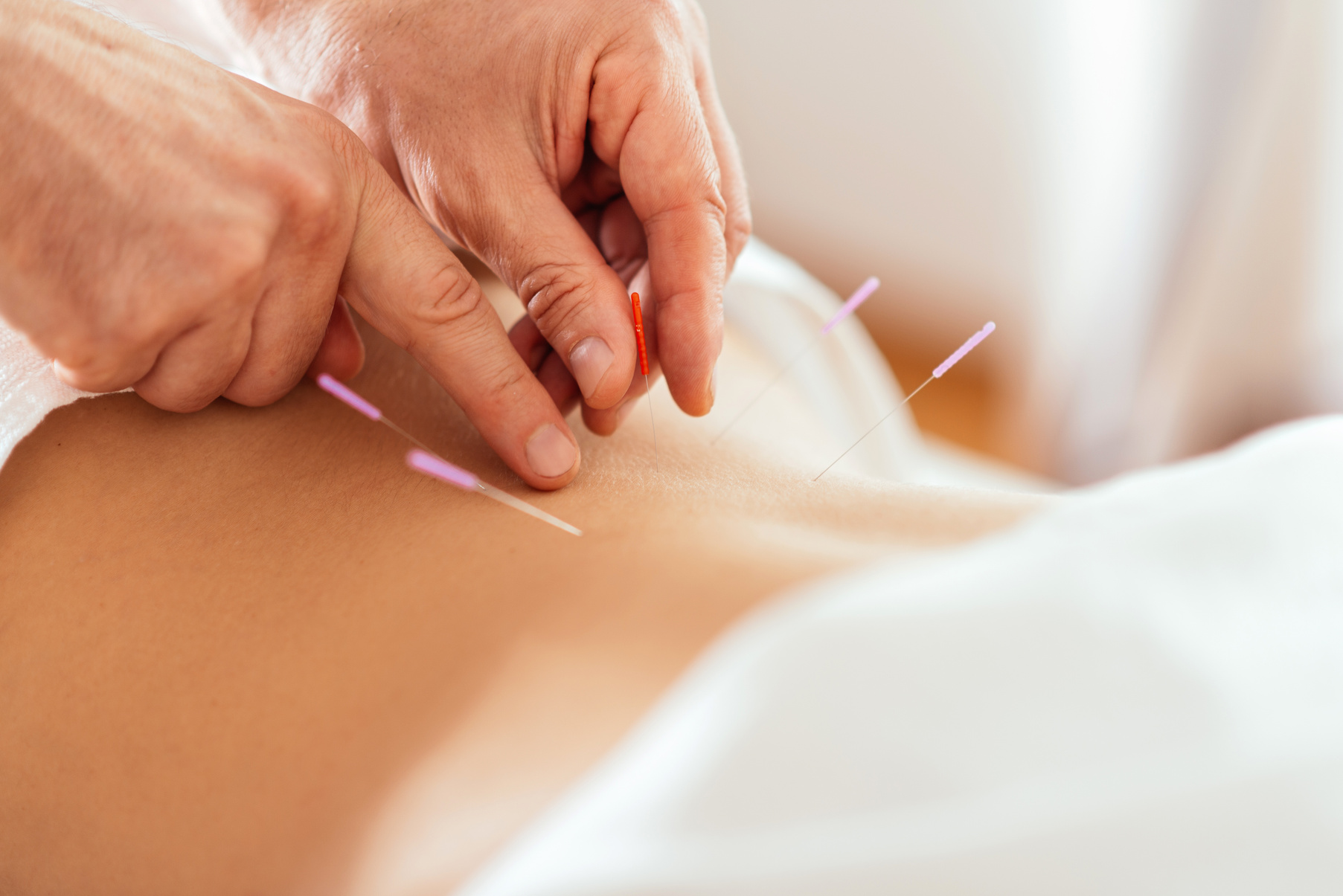 Acupuncture treatment
