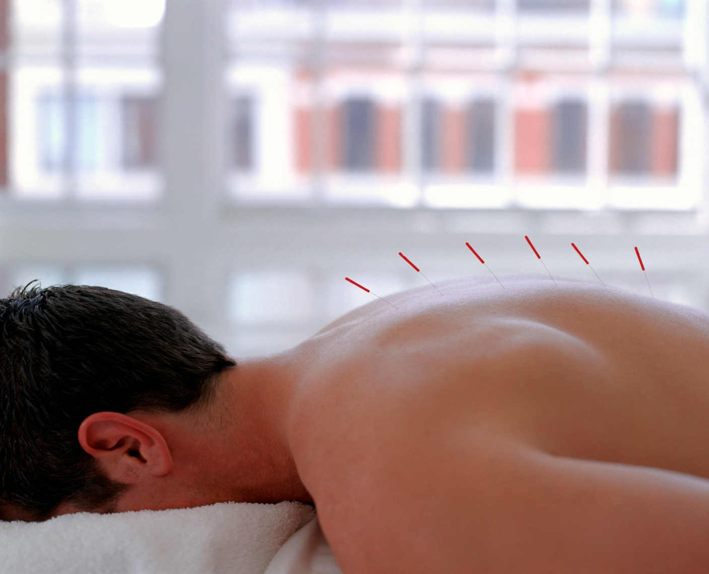 Man with acupuncture needles